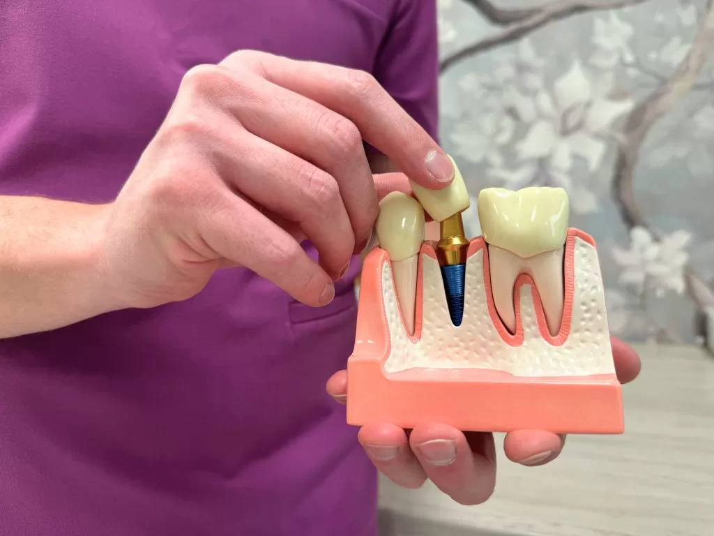 Implanty zębów Implanty zębów