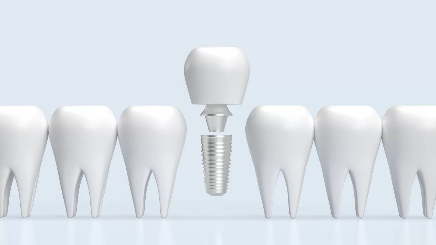 <strong>Implantacja z odroczonym obciążeniem – sprawdzony standard leczenia implantologicznego</strong> <strong>Implantacja z odroczonym obciążeniem – sprawdzony standard leczenia implantologicznego</strong>